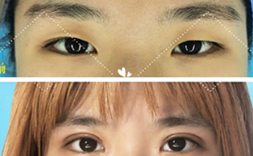 梁偉中做雙眼皮怎么樣？被北京煤醫(yī)一萬多眼綜合案例種草