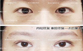 北京張冰潔修復(fù)雙眼皮怎么樣？案例及價格表看技術(shù)亮點