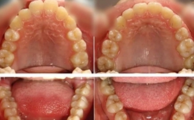 我找青島牙博士王蕓做牙齒矯正，大家覺得效果怎么樣？