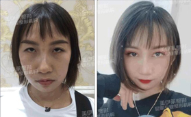 同樣是雙眼皮，怪不得找昆明美伊萊周誠(chéng)做的評(píng)價(jià)很高