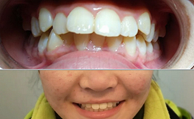 我在青島全好口腔做牙齒矯正真實(shí)感受，附前后對(duì)比照片