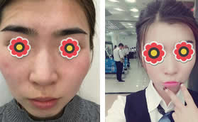 我下巴后縮在河南一科做硅膠假體墊下巴膠布只固定了4天呦!