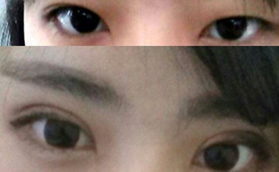 分享我在青島永緣韓美做雙眼皮的真實感受，附對比照片