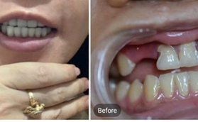 真實(shí)案例告訴你，為什么選擇在南京金鉑利做種植牙