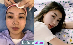 做了超皮秒會(huì)反黑?沈陽(yáng)伊美爾面部祛斑治療案例告訴你原因