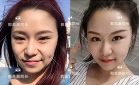 北京郭昌灝AAT全面部脂肪填充術(shù)案例:親測醫(yī)生技術(shù)感覺蠻好