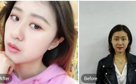 南京韓辰醫(yī)院做玻尿酸隆鼻后悔死了，前后對比圖來看效果