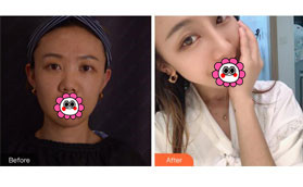 昆明卓星井建醫(yī)生怎么樣?反正我找他做的肋軟骨隆鼻很滿意