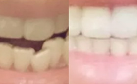 找北京國醫(yī)康口腔苑新永做隱適美隱形矯正效果還蠻不錯的