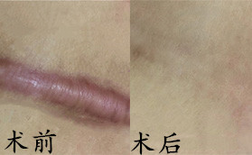 長(zhǎng)沙卓而美醫(yī)療美容醫(yī)院疤痕修復(fù)對(duì)比案例