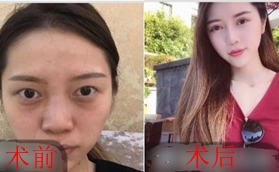 做鼻綜合有沒有后遺癥？看我在南京瑧顏?zhàn)龅男Ч趺礃?></div>
                      </a>
                    </li>
                                                          </ul>
                </td>
            </tr>
          </tbody>
        </table>
      </div>
      <div   id=