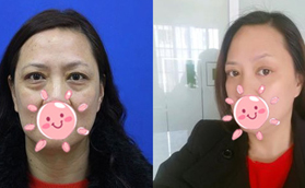 外切去眼袋后的疤痕無法愈合?并不會(huì)，這有真人案例參考哦