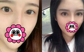 我是在北京巖之畔洛神把雙眼皮寬窄不一樣的形態(tài)調(diào)整好了