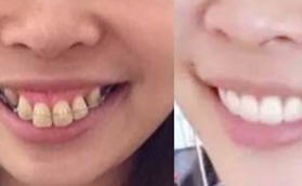 牙齒矯正會改變臉型嗎？我在南京牙院長做完很滿意