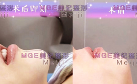 從三組常州美紀(jì)硅膠墊下巴真人案例看，術(shù)后效果到底咋樣
