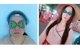 終于在33歲做了四代熱瑪吉全臉除皺，大家來(lái)看效果咋樣