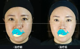 熱瑪吉全臉除皺到底疼不疼？說(shuō)實(shí)話(huà)疼，但效果也是真的好