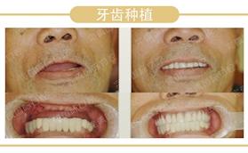 沈陽完佩口腔61歲大爺做完全口種植牙后的真實感受分享