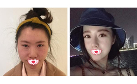 實例對比看蘇州美萊做立秀膨體+耳軟骨墊鼻尖效果好嗎