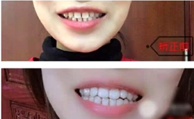牙齒稀疏怎么矯正？看我在南京康貝佳做隱形矯正前后對比