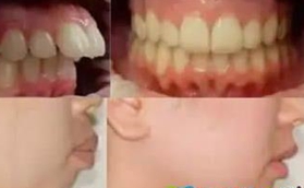 齙牙可以矯正回來嗎？看南京藍鱘口腔牙齒矯正案例就明白