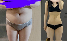 花5萬在韓國做腰腹環(huán)吸真值！3個月水桶腰變成超細螞蟻腰