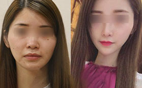 我在合肥蚌埠華美整形做膨體隆鼻