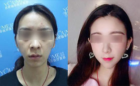 在合肥福華做自體脂肪填充+鼻多項（假體隆鼻+耳軟骨鼻尖）