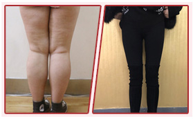 濟南美蓮醫(yī)療美容門診部脂黃金體雕術(shù)對比