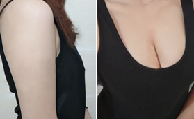 濟(jì)南海峽美容整形醫(yī)院假體隆胸