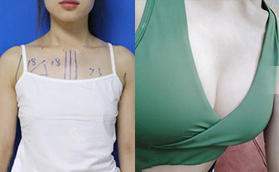 合肥壹加壹假體隆胸項(xiàng)目