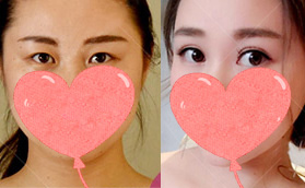 廣東潮州華美整形美容門(mén)診部小護(hù)士雙眼皮蛻變經(jīng)過(guò)