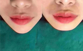 潮州博蘭雅整形玻尿酸豐下巴填充對(duì)比