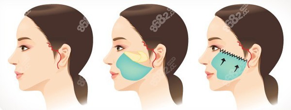 筋膜懸吊面部提升能維持多久 筋膜懸吊面部提升能維持多久