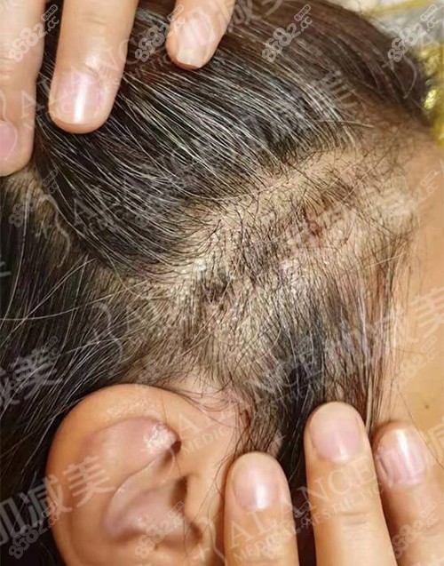 北京加減美范惟面部v6提升做得好嗎